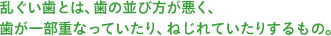 乱ぐい歯とは、歯の並び方が悪く、歯が一部重なっていたり、ねじれていたりするもの。